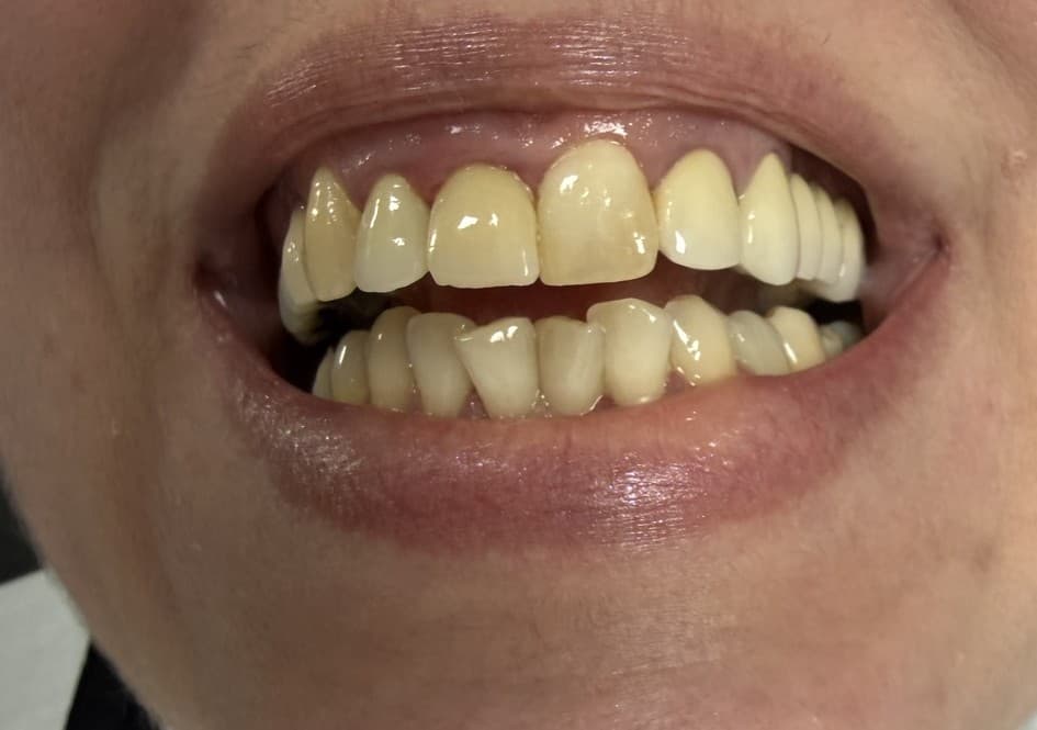 Fractură incisiv central — implant dentar imediat