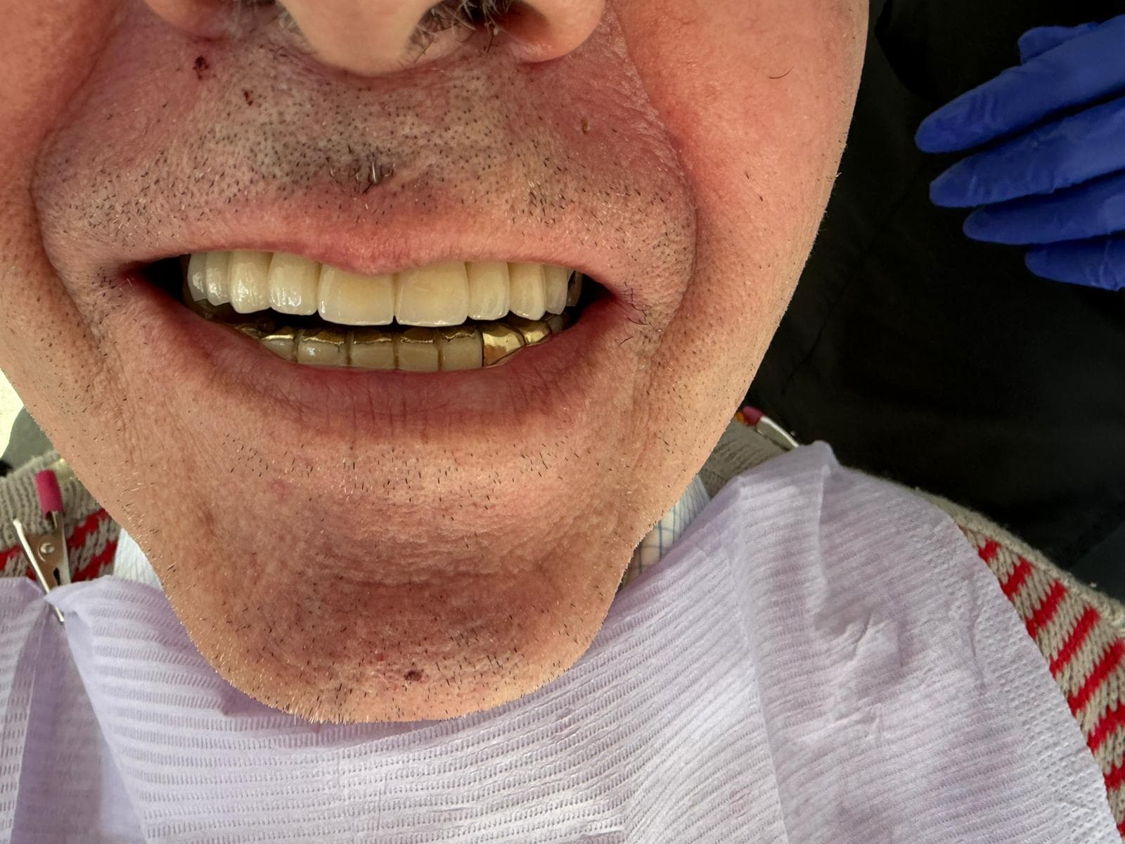 Rezultat după reabilitare orală — Clinica Dr. Miu Buzău