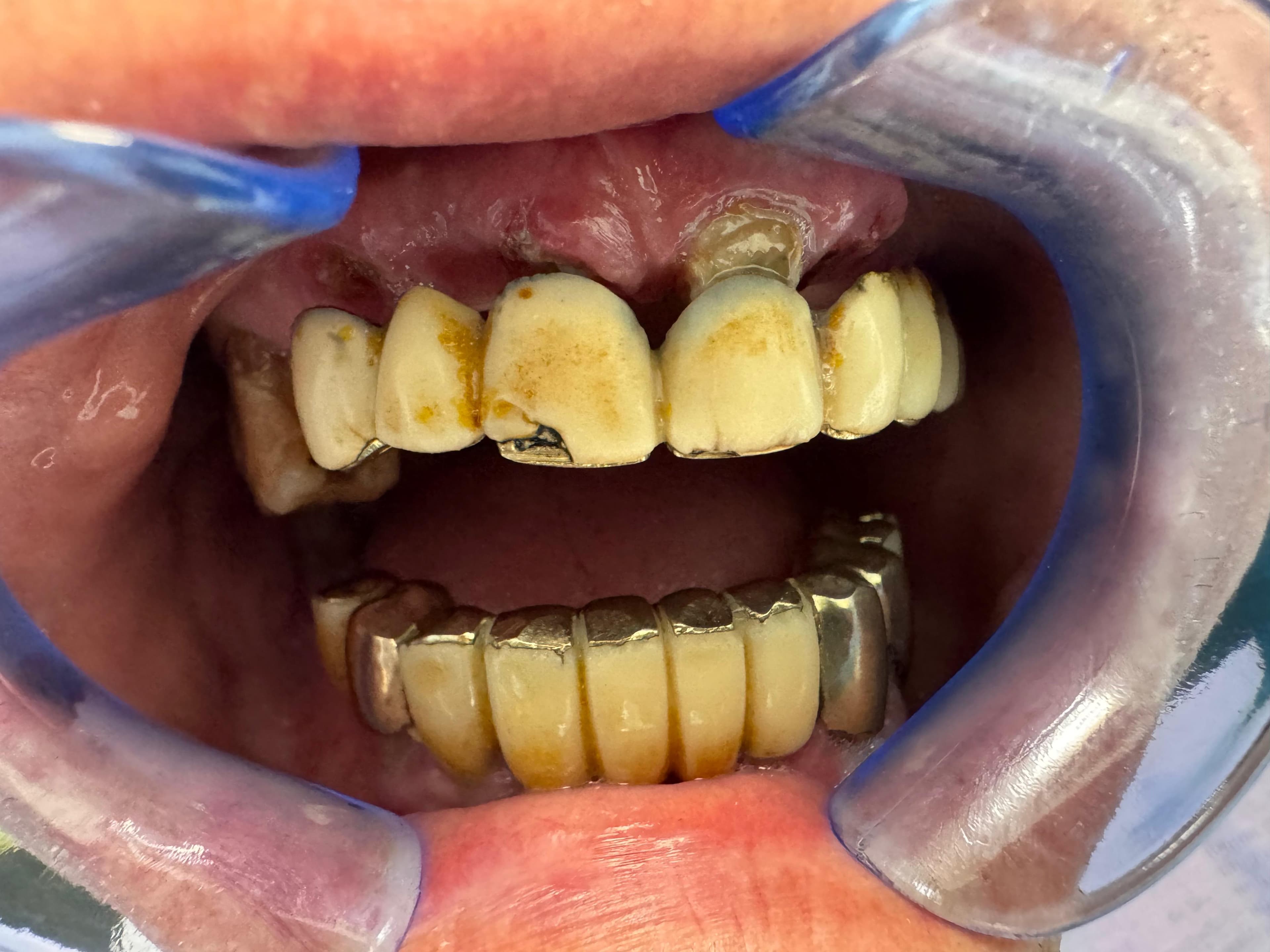Stare inițială înainte de reabilitare orală — Clinica Dr. Miu Buzău