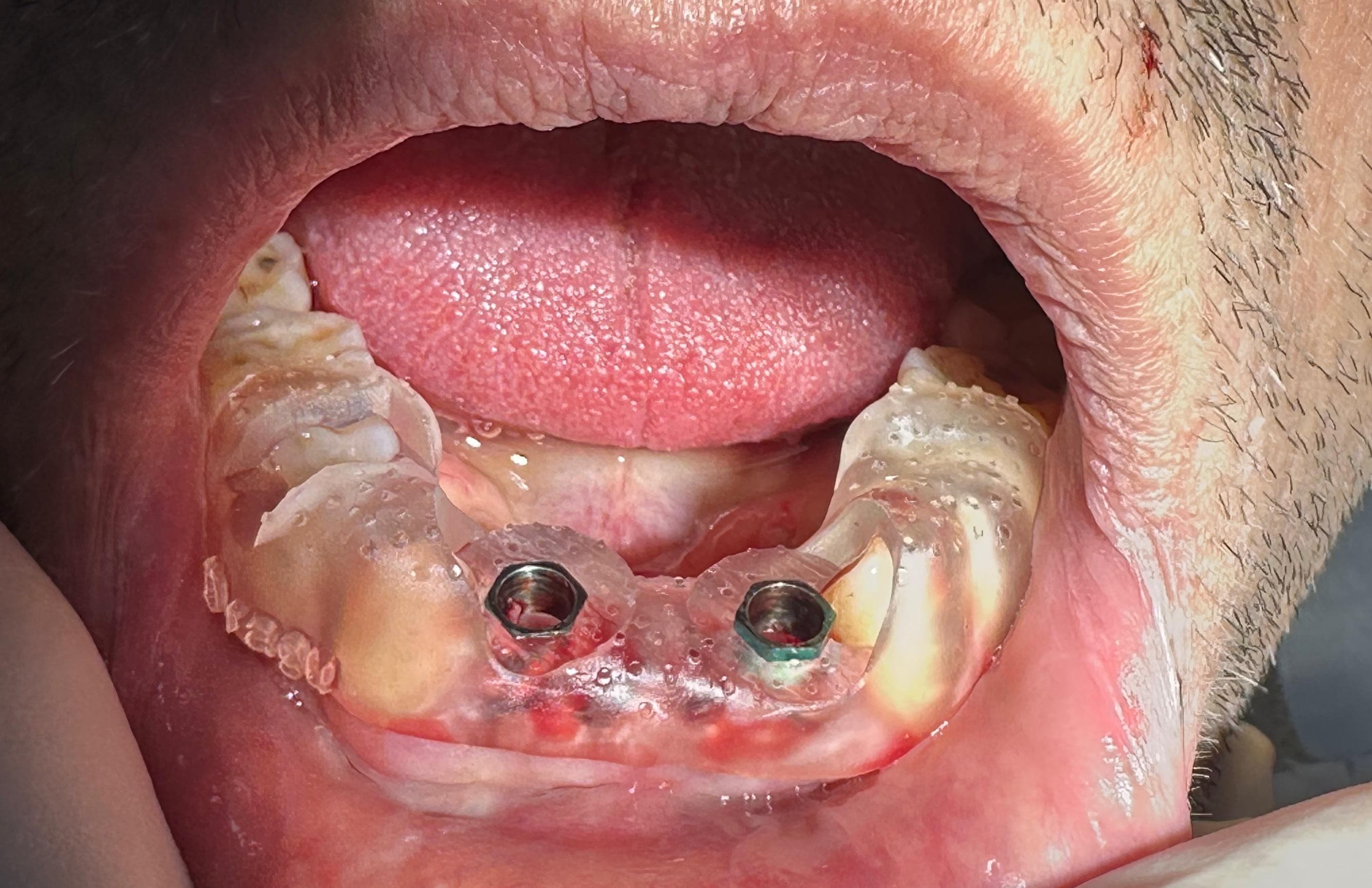 Inserarea implanturilor cu ghid chirurgical